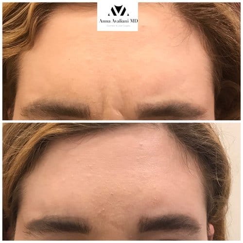 Botox before and after, result 54