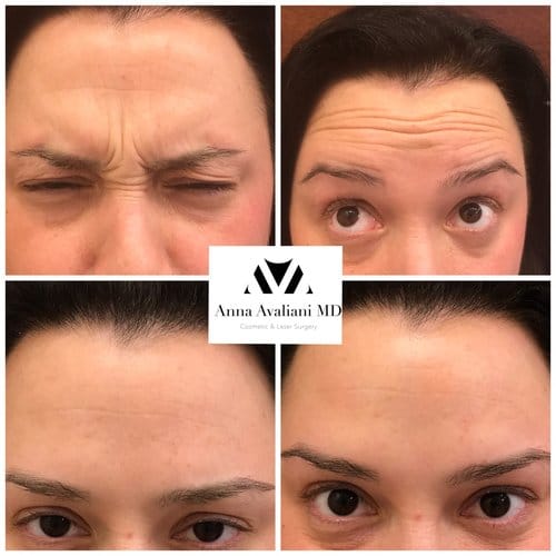 Botox before and after, result 55