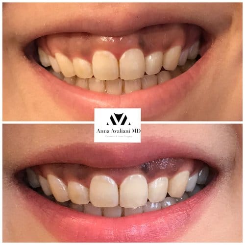 Botox before and after, result 56