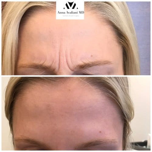 Botox before and after, result 57