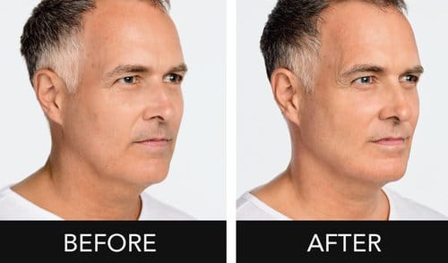 Radiesse before and after, result 1
