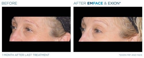 EmFace before and after, result 11