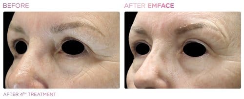 EmFace before and after, result 14