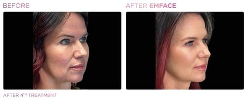 EmFace before and after, result 7