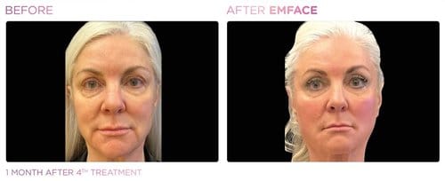 EmFace before and after, result 8
