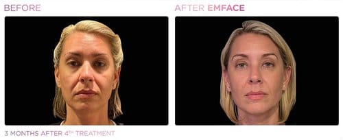 EmFace before and after, result 9