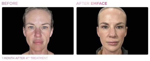EmFace before and after, result 12