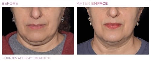 EmFace before and after, result 18