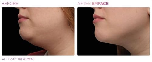 EmFace before and after, result 16