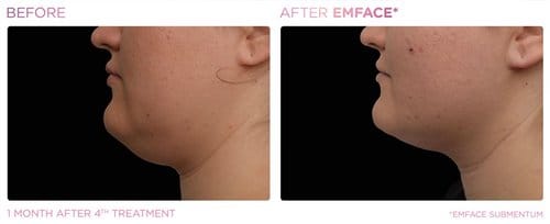 EmFace before and after, result 19