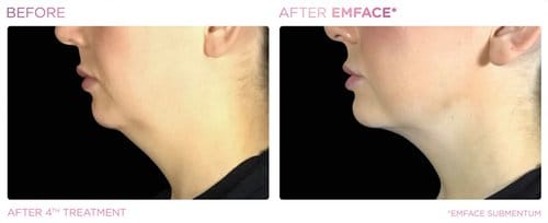 EmFace before and after, result 17