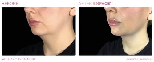 EmFace before and after, result 15