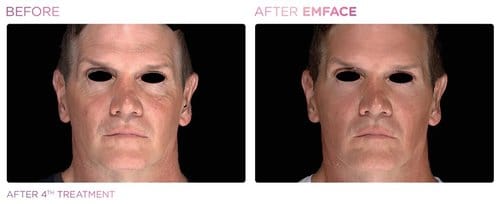 EmFace before and after, result 13