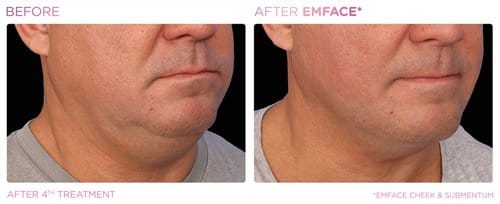 EmFace before and after, result 10