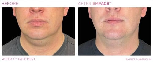 EmFace before and after, result 4