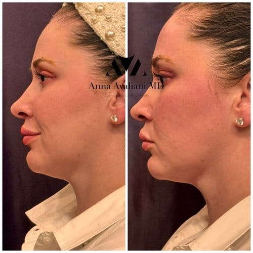 EmFace before and after, result 6