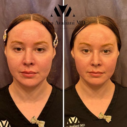 EmFace before and after, result 5
