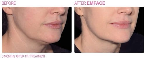EmFace before and after, result 1