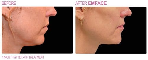 EmFace before and after, result 2