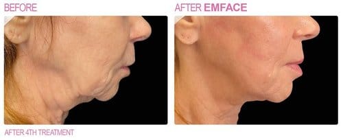 EmFace before and after, result 3
