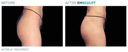 EMSCULPT before and after, result 10