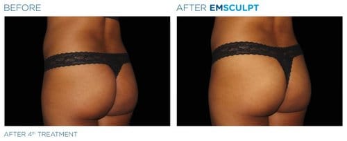 EMSCULPT before and after, result 11