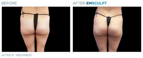 EMSCULPT before and after, result 12