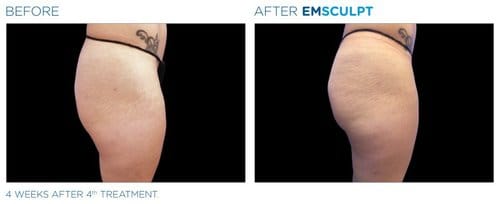 EMSCULPT before and after, result 13