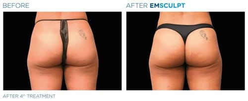 EMSCULPT before and after, result 14