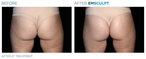 EMSCULPT before and after, result 15
