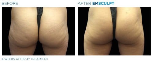 EMSCULPT before and after, result 16