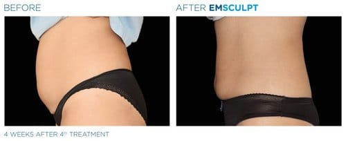 EMSCULPT before and after, result 17