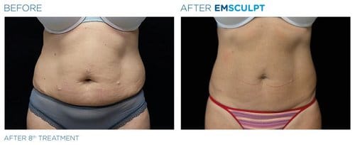 EMSCULPT before and after, result 18