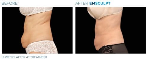 EMSCULPT before and after, result 2