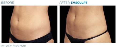 EMSCULPT before and after, result 3