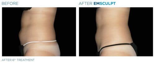 EMSCULPT before and after, result 4