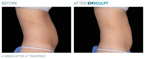 EMSCULPT before and after, result 5