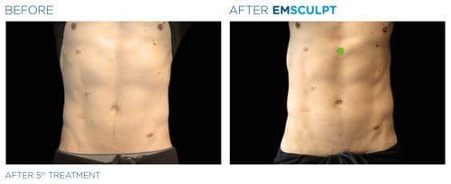 EMSCULPT before and after, result 6