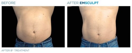 EMSCULPT before and after, result 7