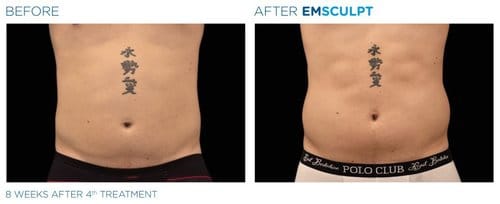 EMSCULPT before and after, result 8
