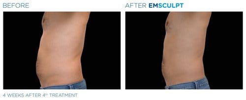 EMSCULPT before and after, result 9