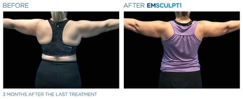 Emsculpt NEO before and after