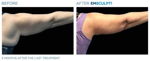 Emsculpt NEO before and after
