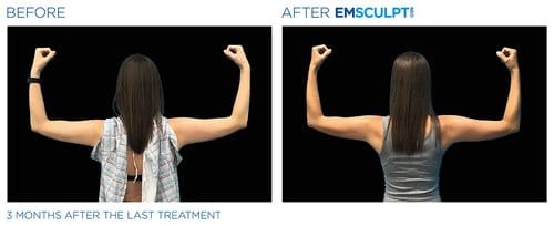 Emsculpt NEO before and after, result 5