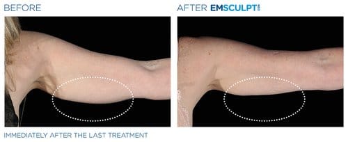 Emsculpt NEO before and after, result 3