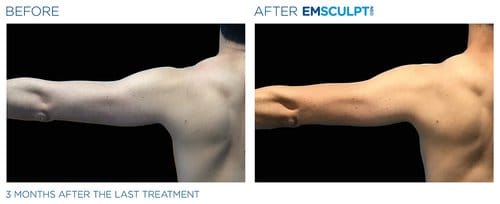 Emsculpt NEO before and after, result 4