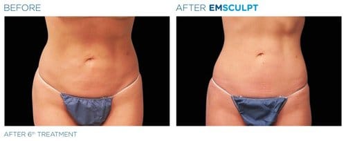 EMSCULPT before and after, result 1