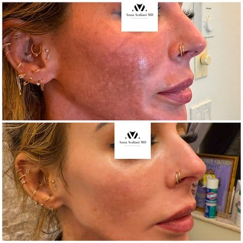 PicoSure / Laser Skin Rejuvenation before and after, result 1