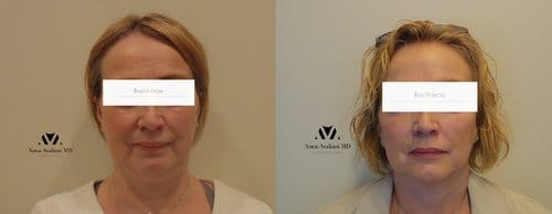 Fillers before and after, result 34