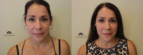 Fillers before and after, result 35